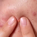 पिंपल्स को कहें अलविदा! अपनाएं ये असरदार घरेलू नुस्खे