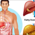 हर तीसरे भारतीय को है फैटी लिवर की समस्या: जानें लक्षण, कारण और लिवर को हेल्दी रखने के टिप्स