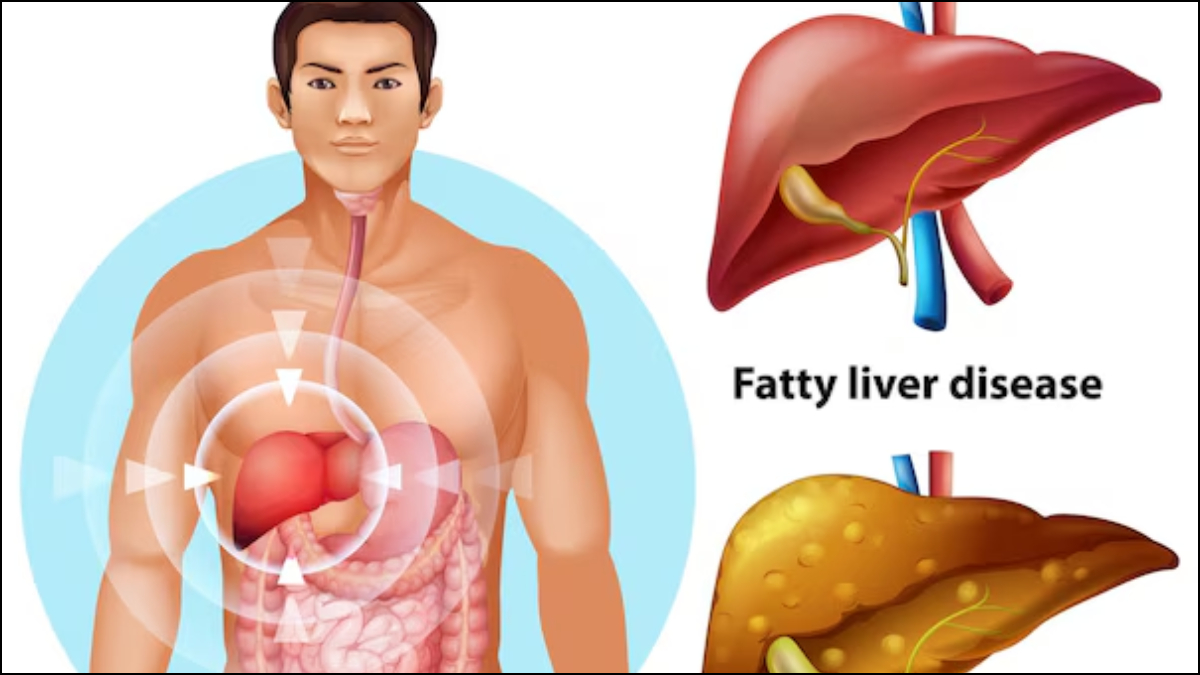 You are currently viewing हर तीसरे भारतीय को है फैटी लिवर की समस्या: जानें लक्षण, कारण और लिवर को हेल्दी रखने के टिप्स