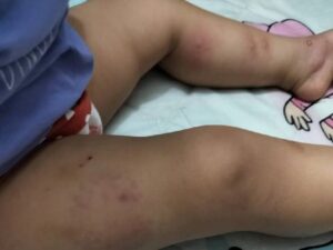 Read more about the article सहायिका ने बच्ची को थप्पड़ और मुक्के मरे, फिर दीवार में फेंका: 15 माह की मासूम पर बर्बरता का CCTV फुटेज सामने आया, मां को जांघ पर निशान देखकर हुआ था शक; डे-केयर संचालिका और सहायिका पर केस दर्ज!